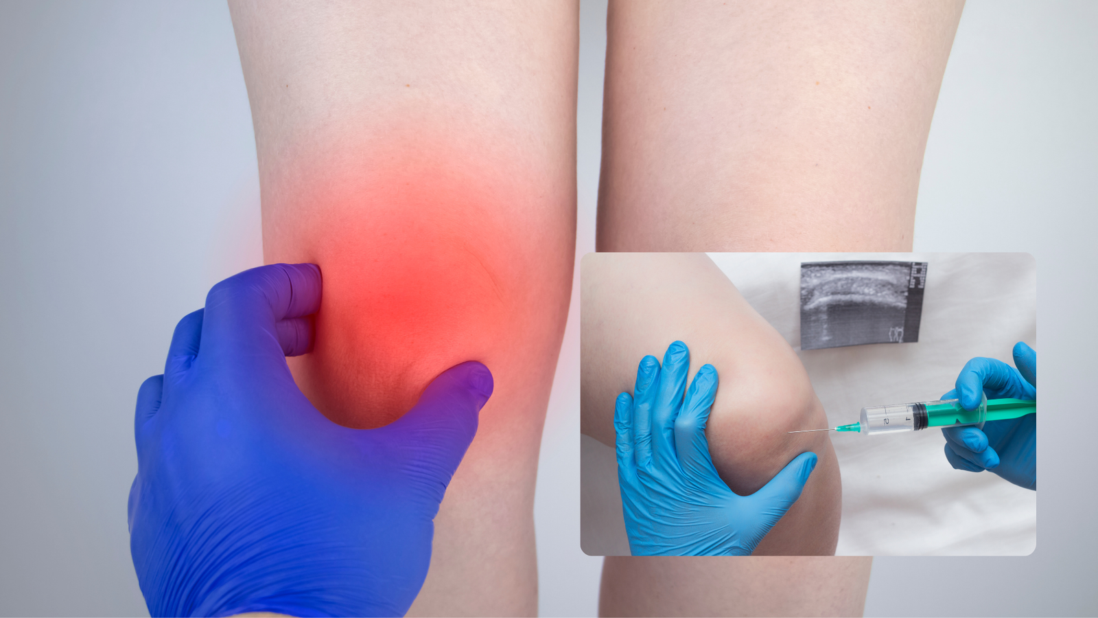 Plasma Rico en Plaquetas (PRP): Una Opción Beneficiosa para Tendinopatías.