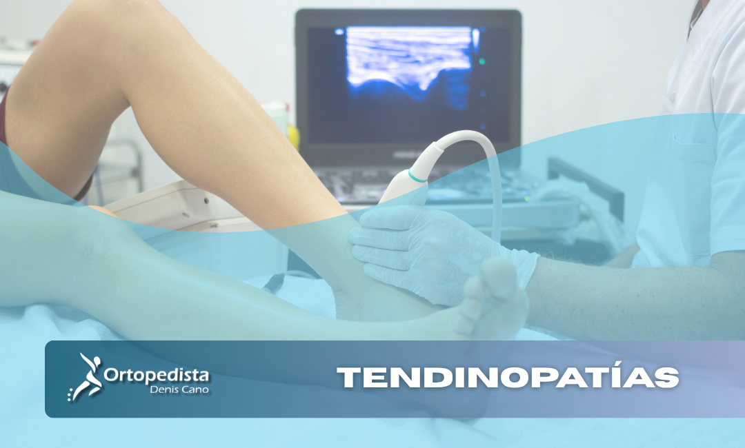 ¿Tendinopatía que no mejora? Cómo tratar lesiones de tendón sin cirugía