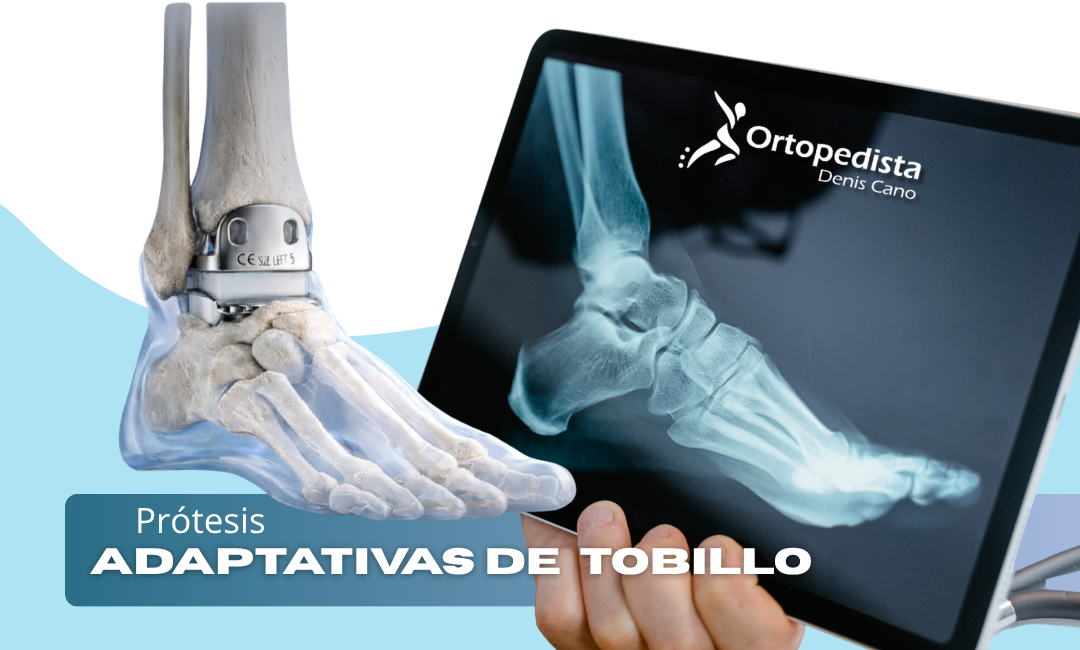 La Revolución de las Prótesis Adaptativas de Tobillo: Superando la Fijación Ósea en Medellín