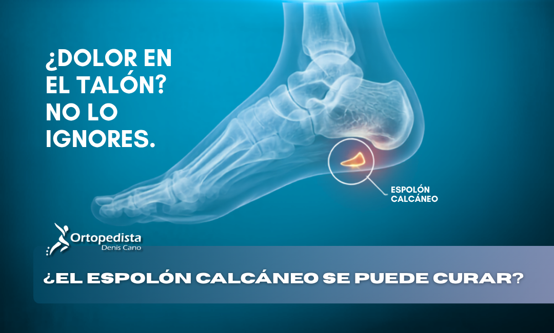 Espolón calcáneo: ¿qué es, por qué aparece y cómo se trata el dolor de talón?